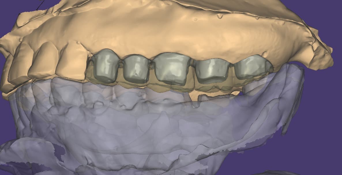 Anterior bridge detail — dental restoration by Shanti Dental Lab