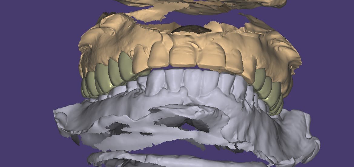 Full arch side — dental restoration by Shanti Dental Lab