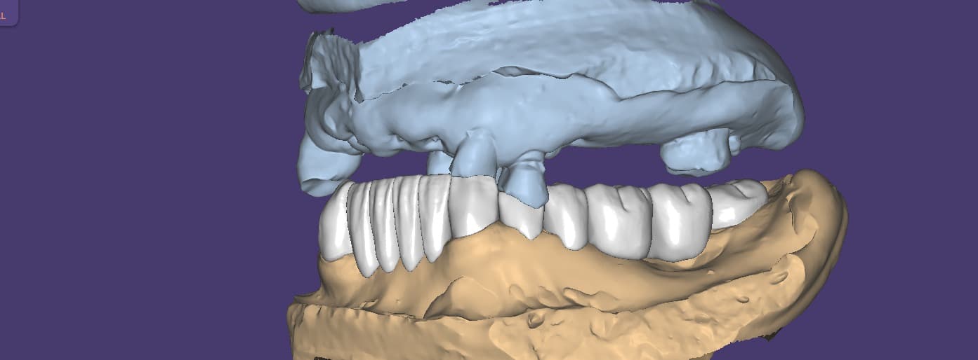 Implant side view — dental restoration by Shanti Dental Lab